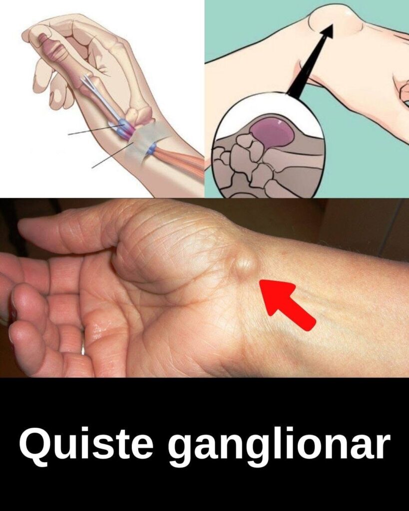 Quistes Ganglionares Qu Son Por Qu Aparecen Y C mo Se Tratan quistes-ganglionares-qu-son-por-qu-aparecen-y-c-mo-se-tratan